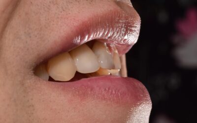 Jak předejít zubnímu kazu?