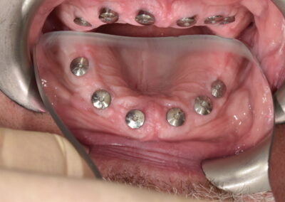 bezzubá čelist osazená 6 implantáty připravená na nasazení protetické práce