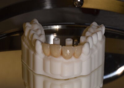 náhrada předních zubů připravená k odevzdání